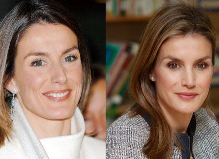 Según fuentes oficiales de la Casa Real la rinoplastia de Letizia se debio a causas médicas.