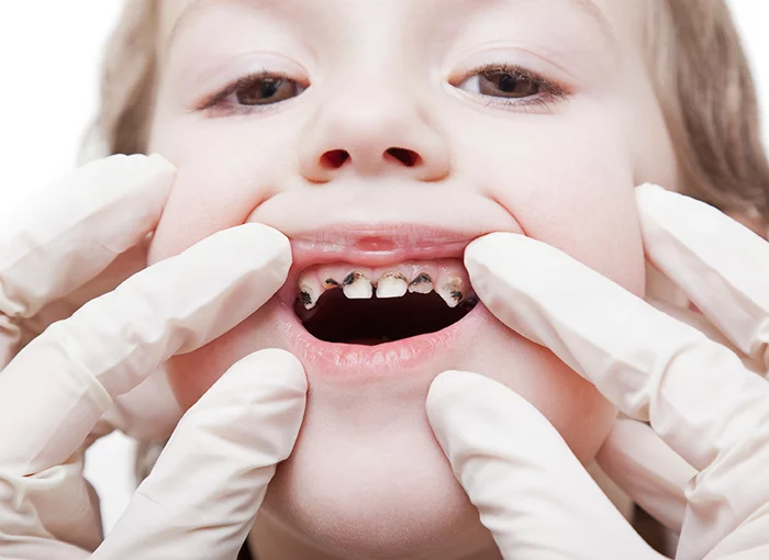 Las caries dentales pueden aparecer por un exceso de azúcar.