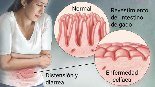 Qué es la enfermedad celíaca 