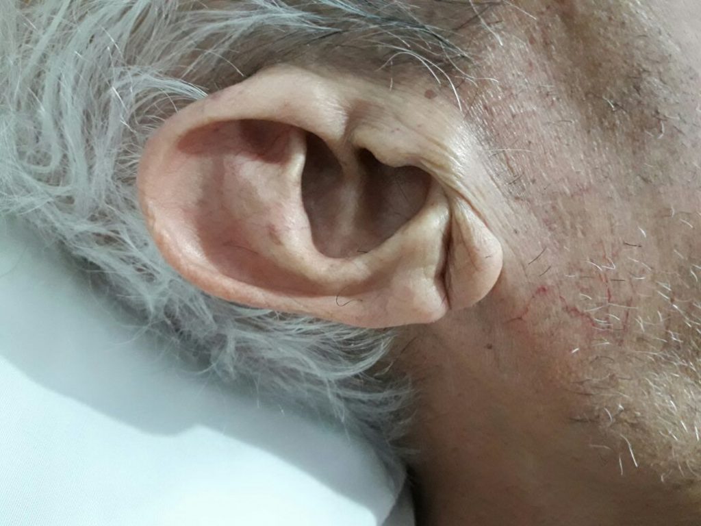 signo de Frank infartos