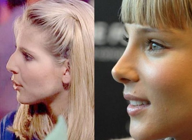LA RINOPLASTIA DE ELSA PATAKY