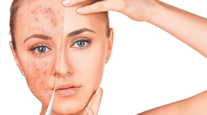 sol acne juvenil