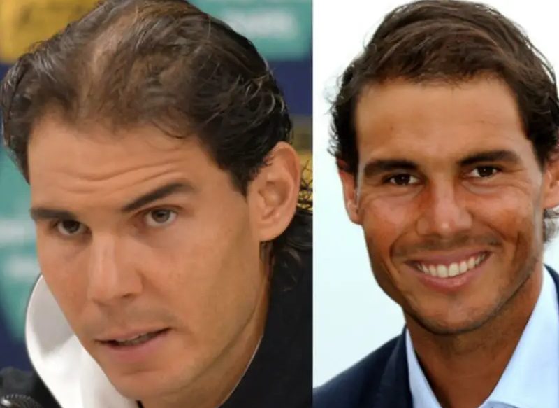 LA PÉRDIDA DE PELO DE RAFA NADAL