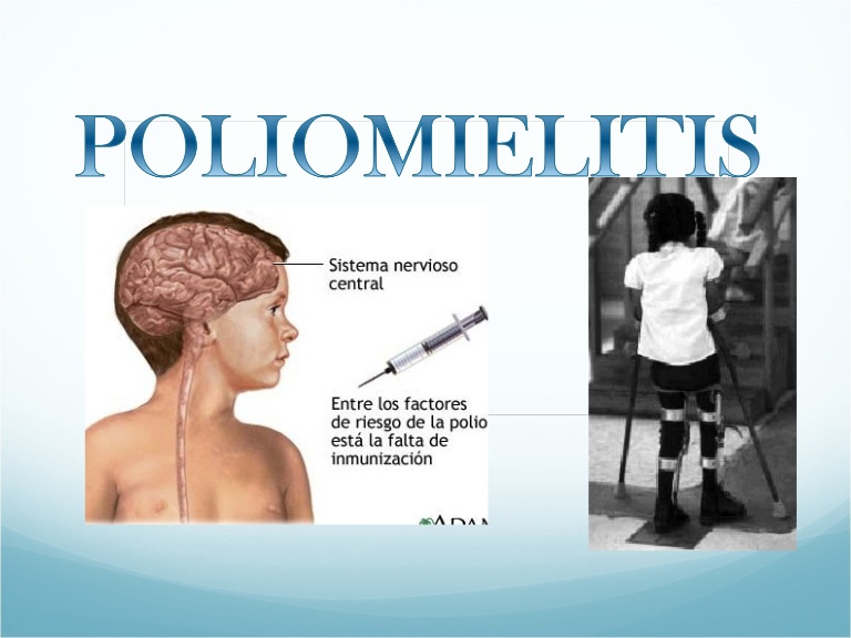 Qué es la poliomielitis