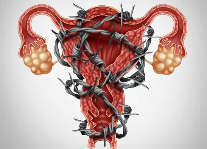 endometriosis-dolor