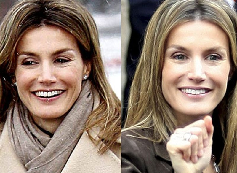 LOS BRACKETS DE LA REINA LETIZIA