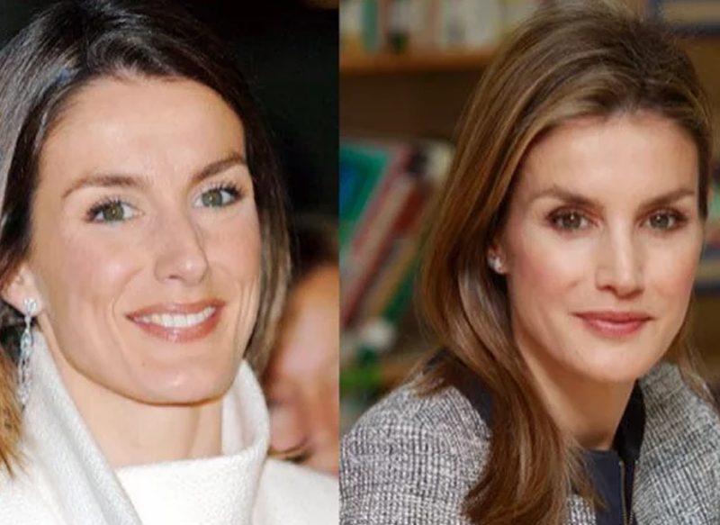 LA RINOPLASTIA DE LA REINA LETIZIA