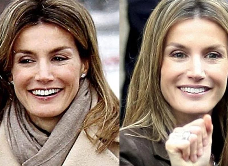 LA ORTODONCIA DE LA ESPOSA DE FELIPE VI