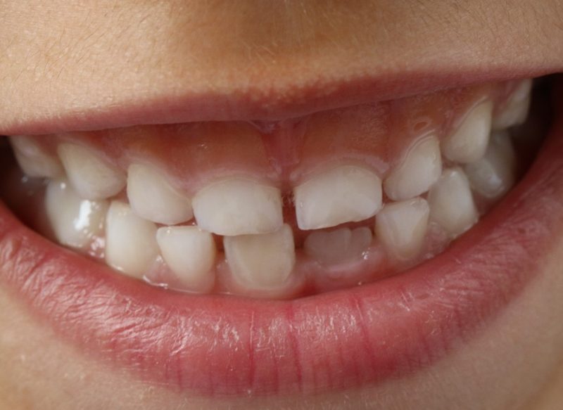 SUEÑO CON LA CAÍDA DE LAS PIEZAS DENTALES INFERIORES