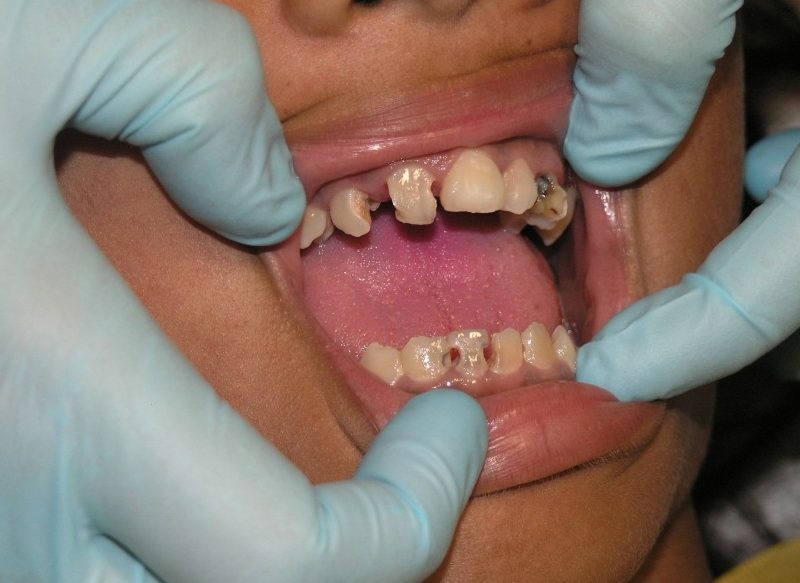 SOÑAR CON CARIES