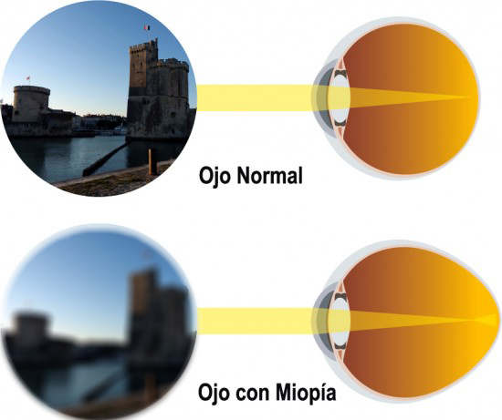 miopía ojo Moncloa