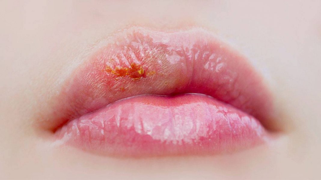 herpes labial