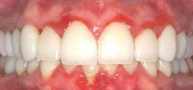 Gingivitis descamativa crónica- Encías