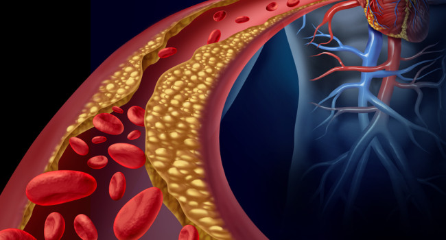 hipercolesterolemia