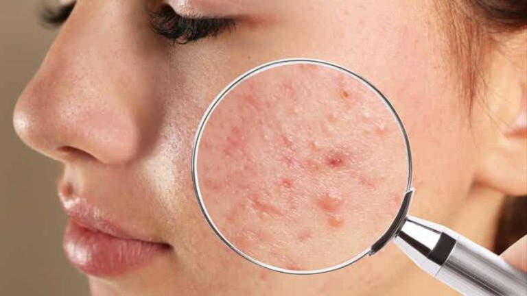 Estos remedios caseros eliminarán el acné para siempre