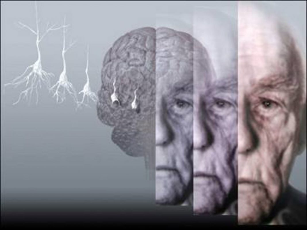 Se necesitan nuevas investigaciones para diagnosticar el Alzheimer de forma temprana