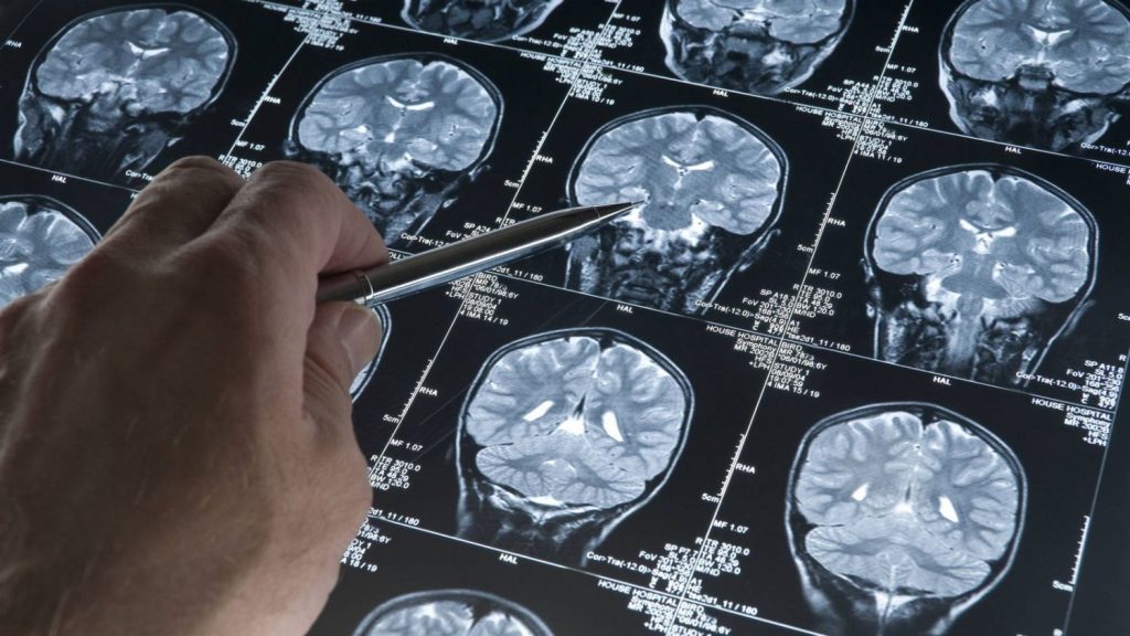 De que manera afecta el Alzheimer al cerebro