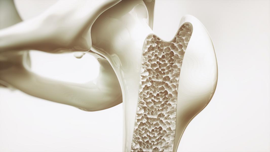 ¿Qué es la osteoporosis?