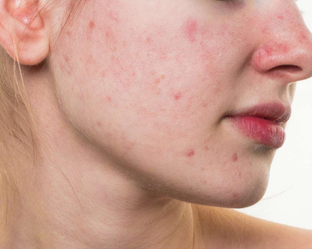 El acné: una enfermedad que afecta a millones