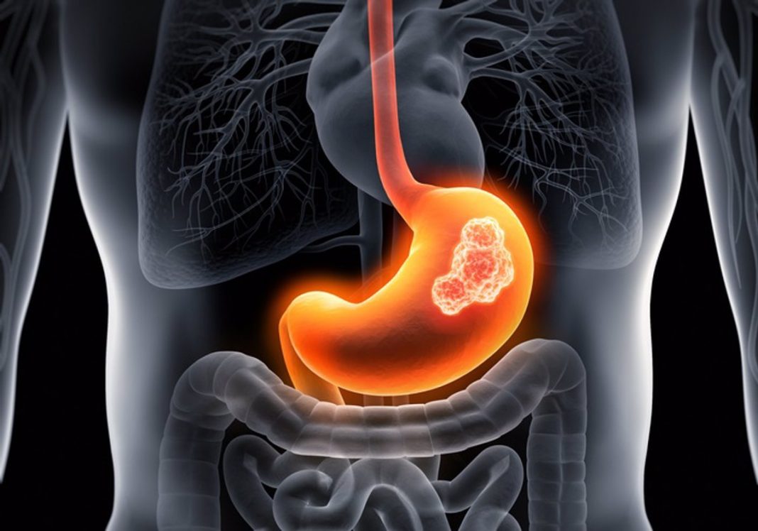 ¿En dónde se forma el cáncer?