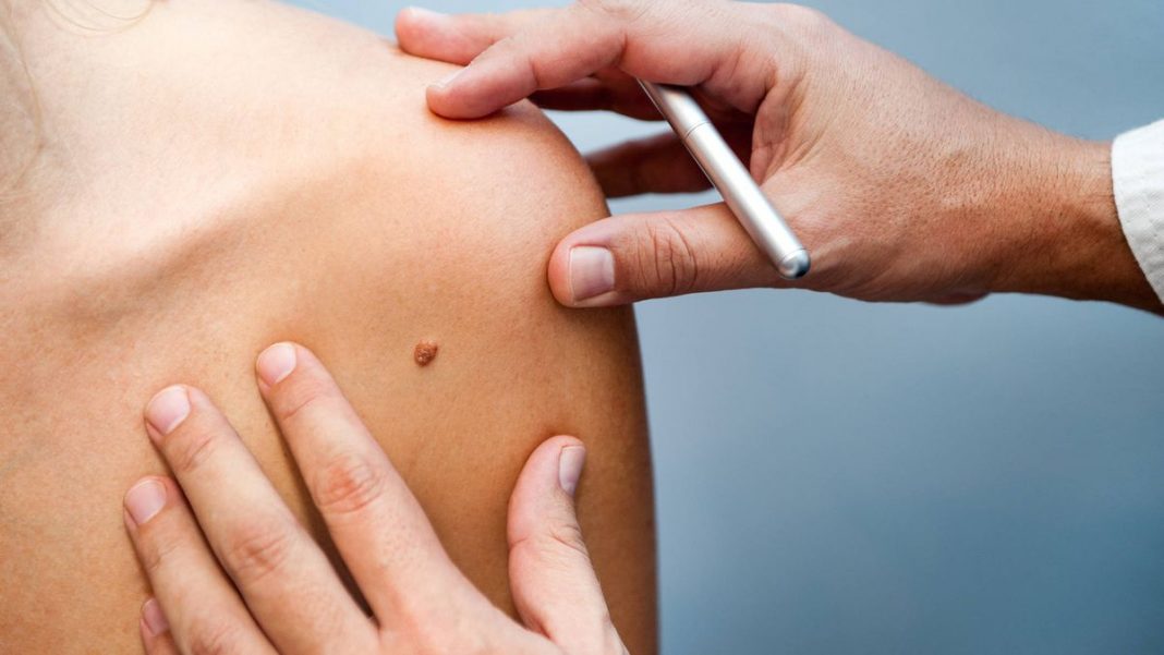 La diferencia entre un lunar y un melanoma