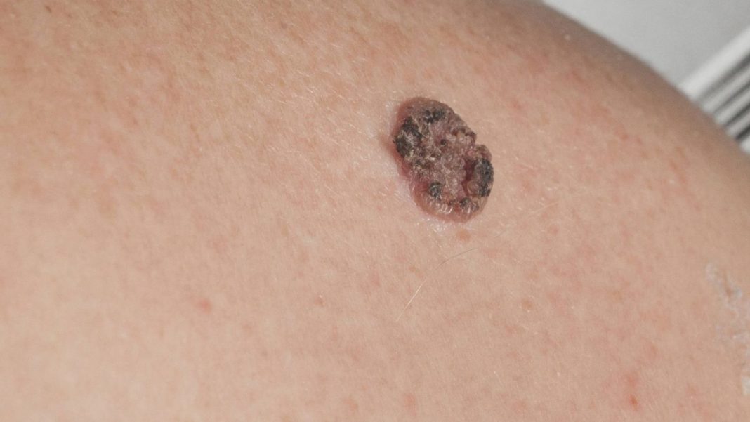 ¿Qué es un melanoma?