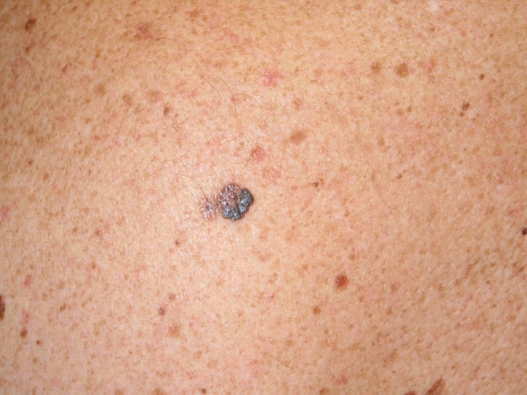 El peligro de tener un melanoma