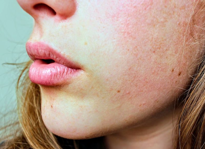 LAS DUDAS SOBRE LA PIEL SECA DEL ROSTRO