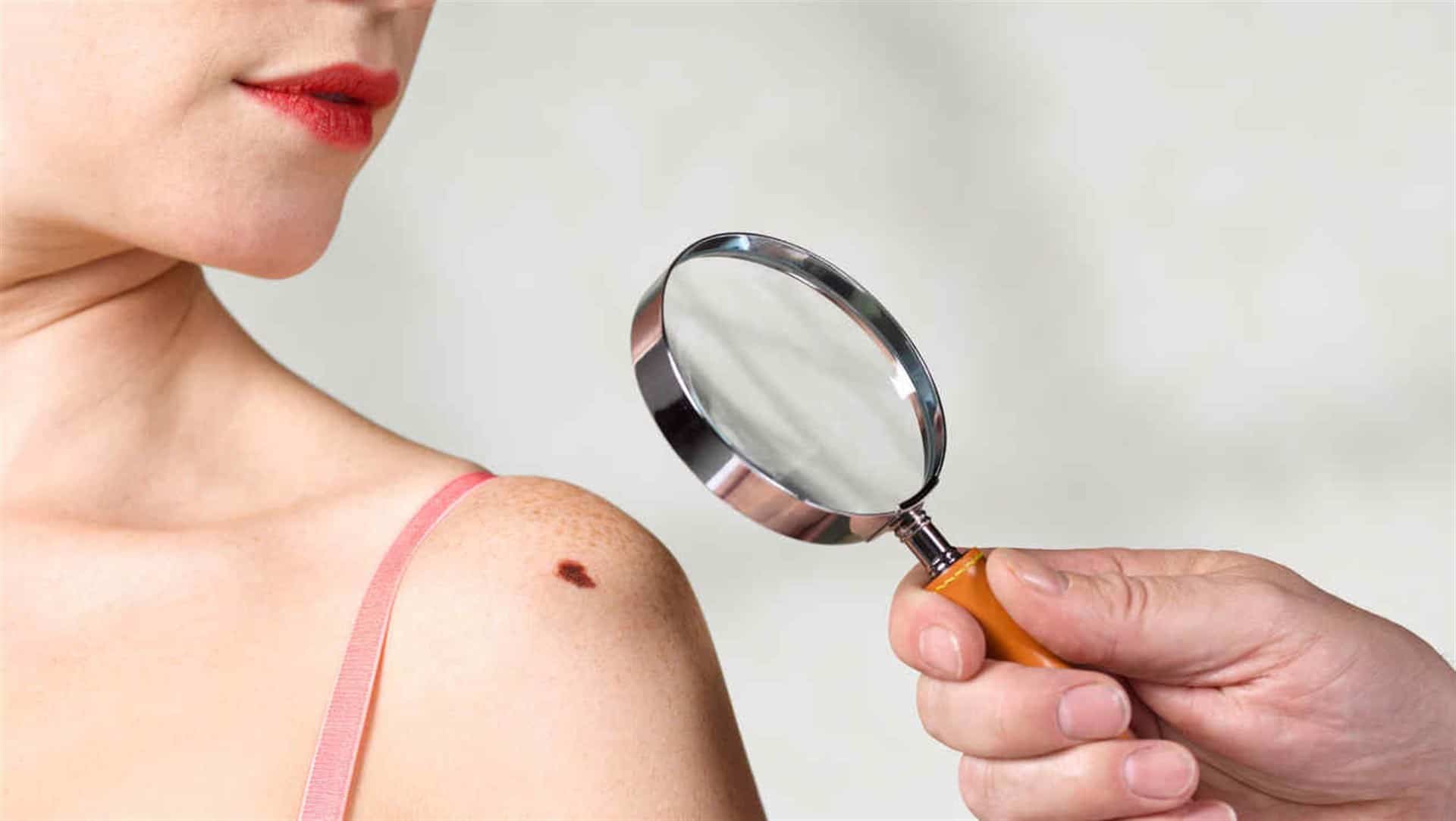 Examinar la piel con una lupa para detectar el cáncer de piel