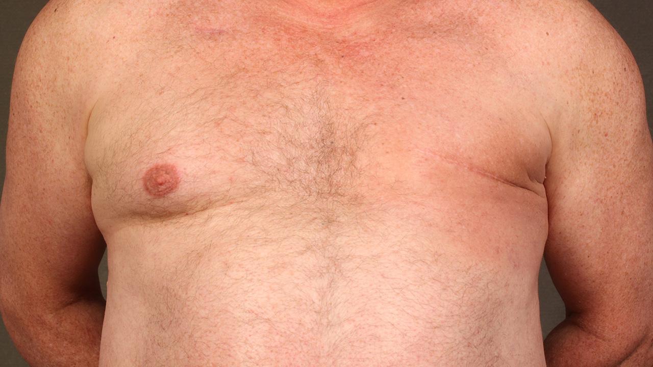 Cáncer de mama en hombres: 5 síntomas que debes tener en cuenta 2 Moncloa Inversión del pezón: un síntoma de cáncer de mamas en hombres