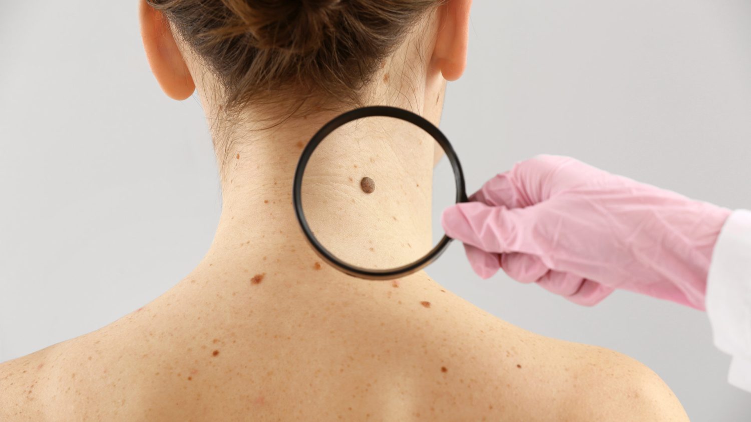 Cómo detectar el cáncer de piel en una fase temprana 2 Moncloa Cómo detectar el cáncer de piel en una fase temprana