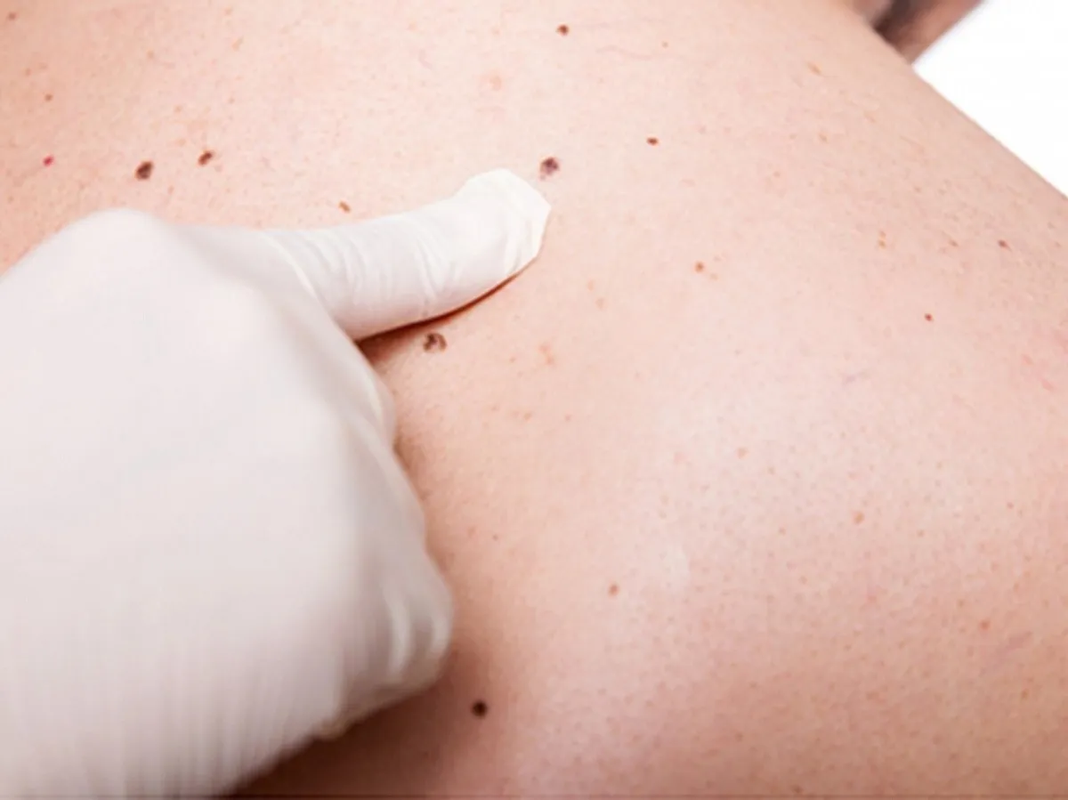 Realizar un autoexamen de la piel para detectar el cáncer de piel