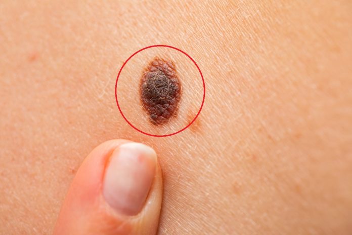 cáncer de piel