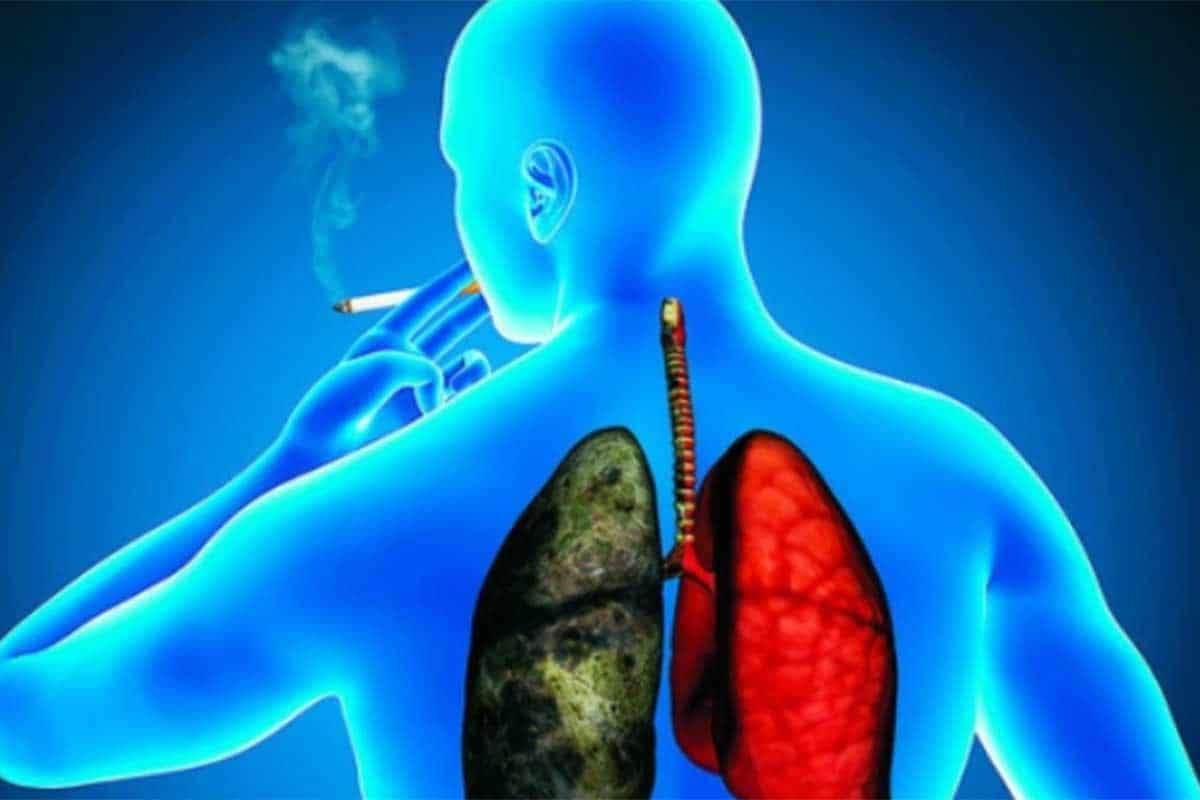 Detección temprana del cáncer de pulmón mejora supervivencia