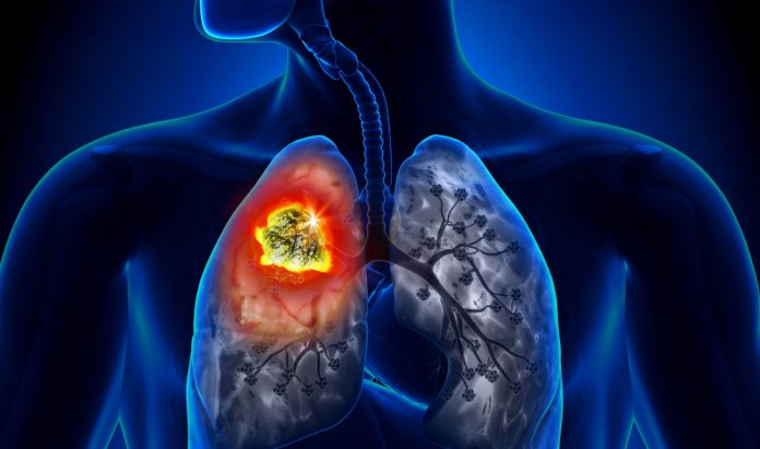 Cáncer de pulmón