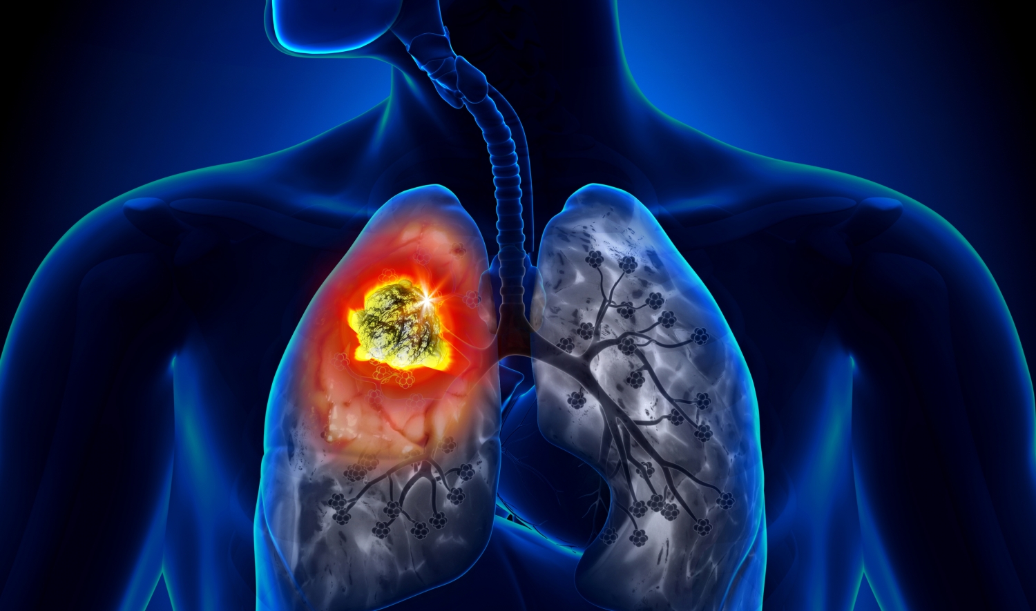 Cáncer de pulmón