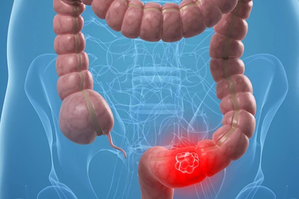 Cáncer colorrectal: como la detección temprana puede salvar vidas 2 Moncloa Quién debe someterse a la detección del cáncer colorrectal
