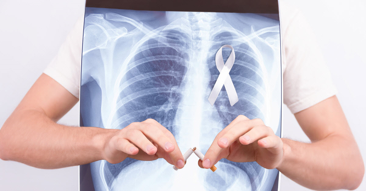 Cáncer de pulmón: el riesgo aumenta con la edad