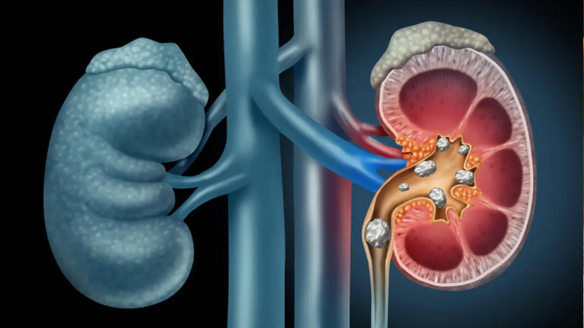 Complicaciones de la enfermedad renal crónica