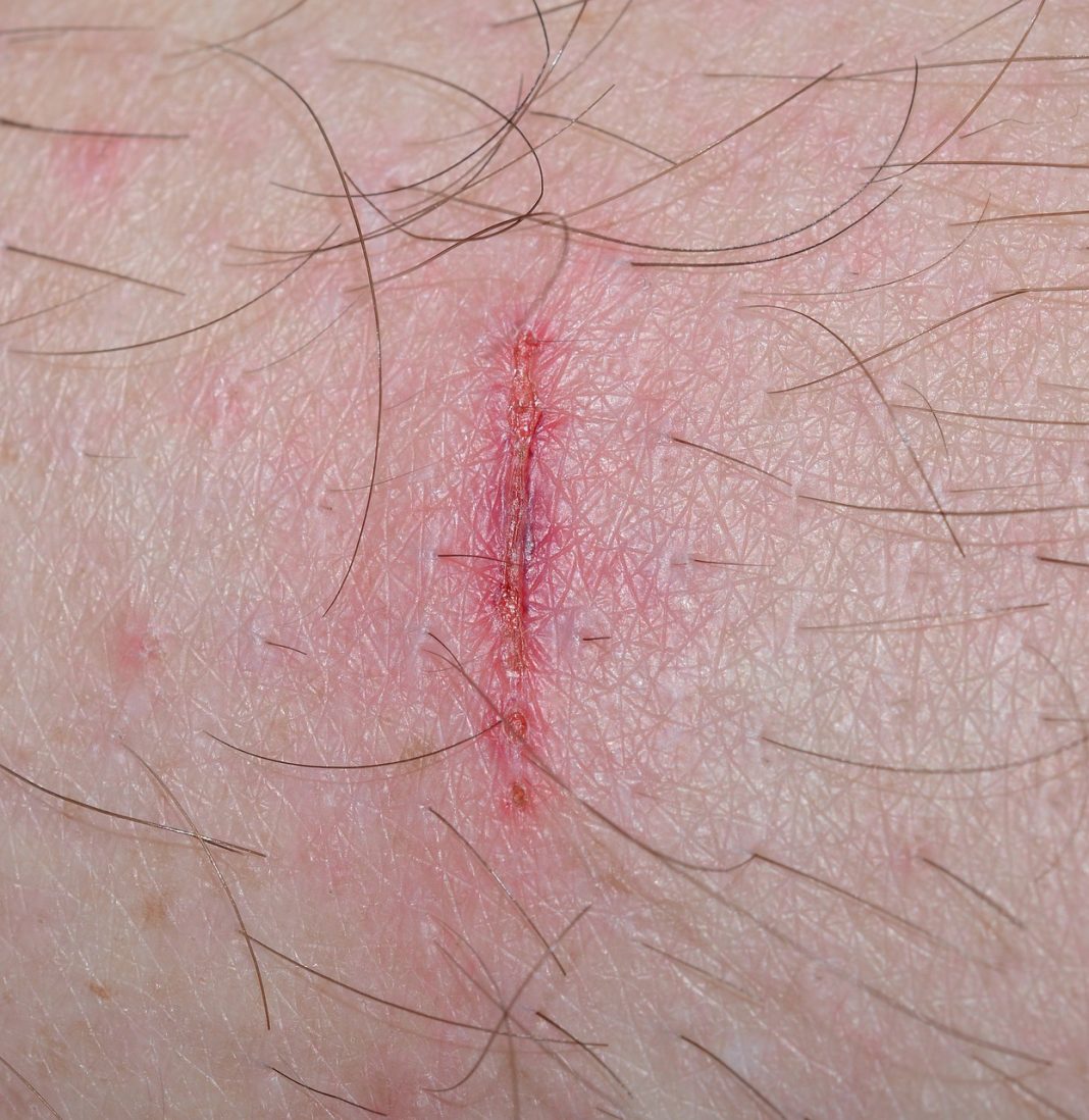 cura las heridas