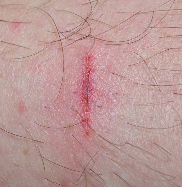 cura las heridas
