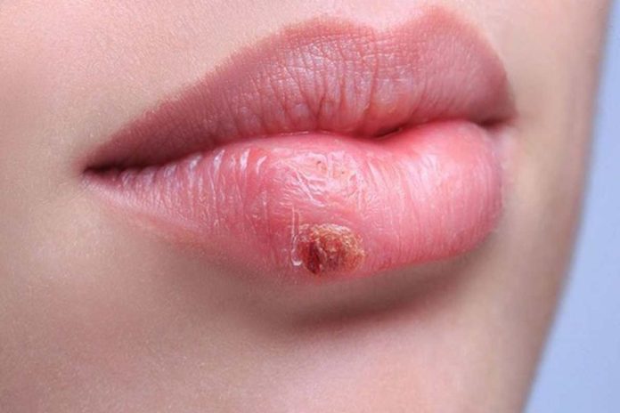 herpes