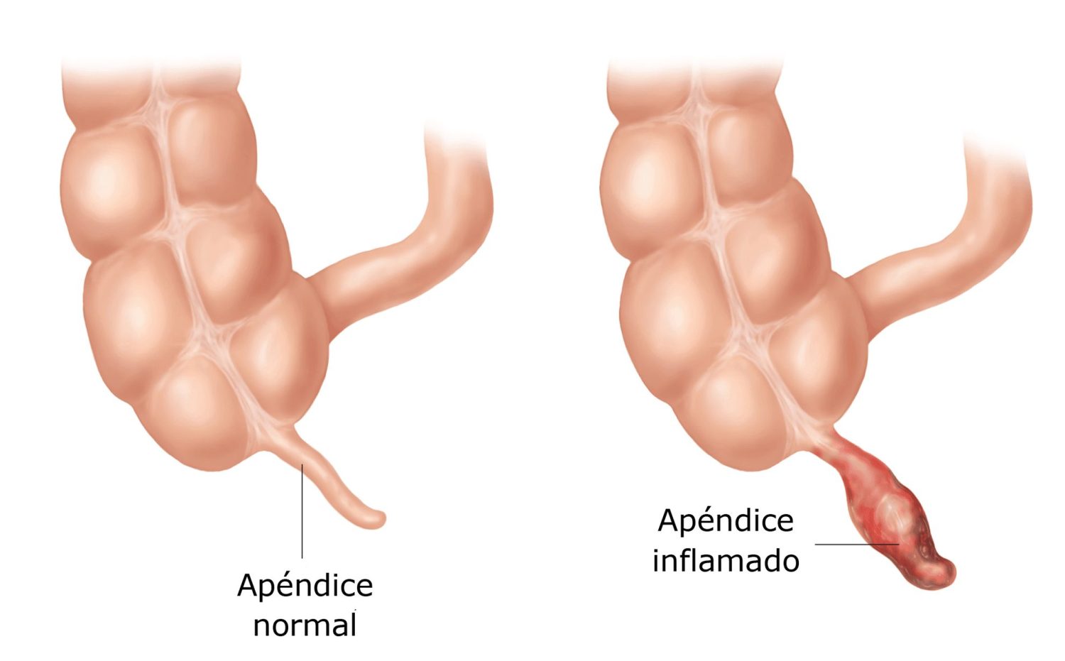Detecta la apendicitis con destreza: síntomas clave y claves para diferenciarla de otras enfermedades. ¡Conócelo todo para cuidarte! 2 Moncloa PÉRDIDA DE APETITO, DOLOR AL MOVER LA PIERNA DERECHA