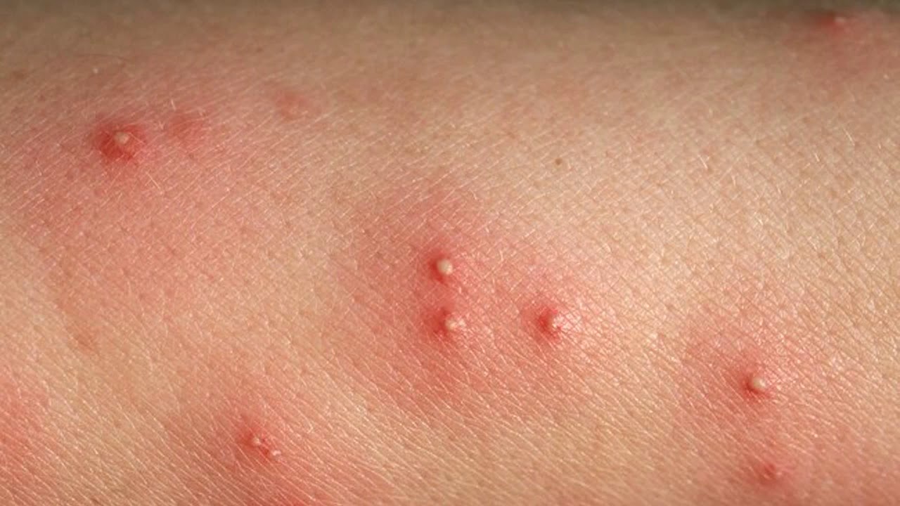 Descubre trucos caseros infalibles para erradicar granos en espalda y glúteos. ¡Libérate de imperfecciones con estos consejos efectivos! 3 Moncloa ESTRATEGIAS DE ESTILO DE VIDA Y MANEJO DEL ESTRÉS