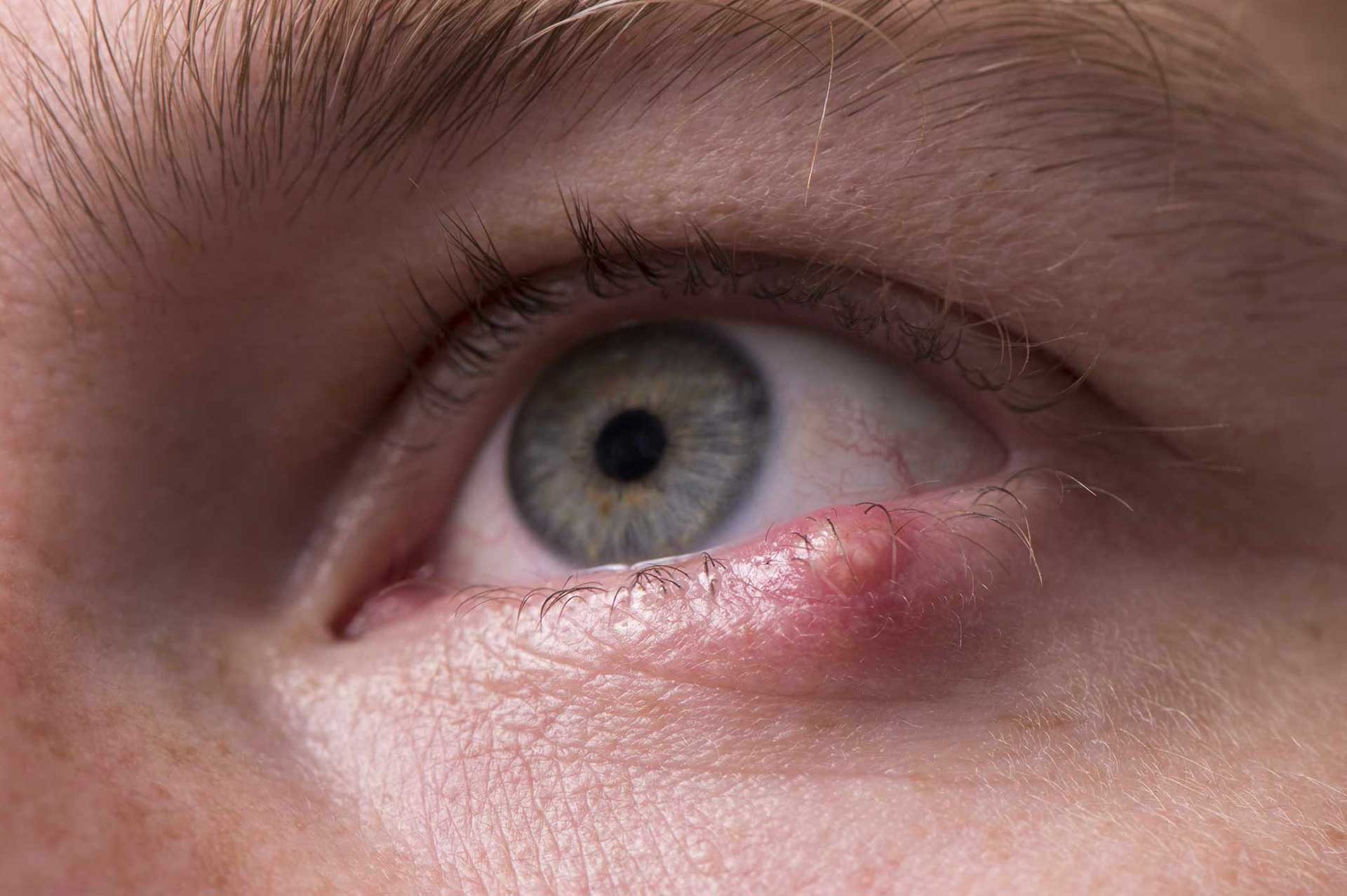 Libérate de los orzuelos con 8 eficaces soluciones: descubre el camino hacia unos ojos saludables y radiantes 4 Moncloa EDUCACIÓN PARA LA SALUD VISUAL EN LA VIDA COTIDIANA