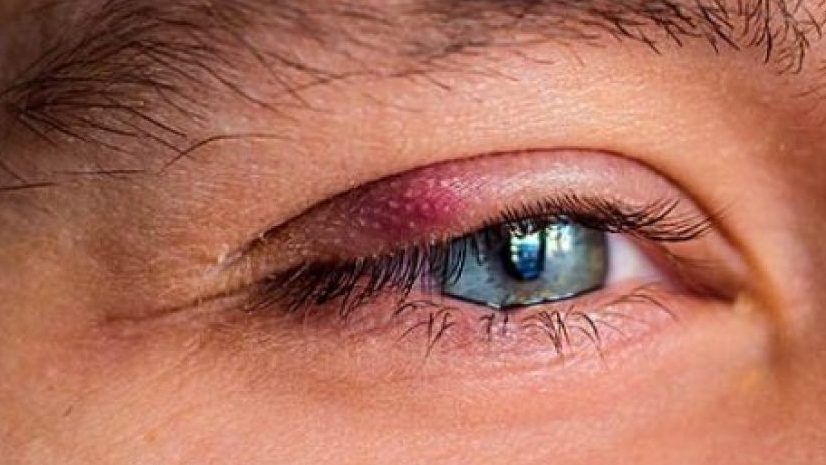 Libérate de los orzuelos con 8 eficaces soluciones: descubre el camino hacia unos ojos saludables y radiantes 3 Moncloa LA IMPORTANCIA DE LA HIGIENE EN LOS ACCESORIOS OCULARES
