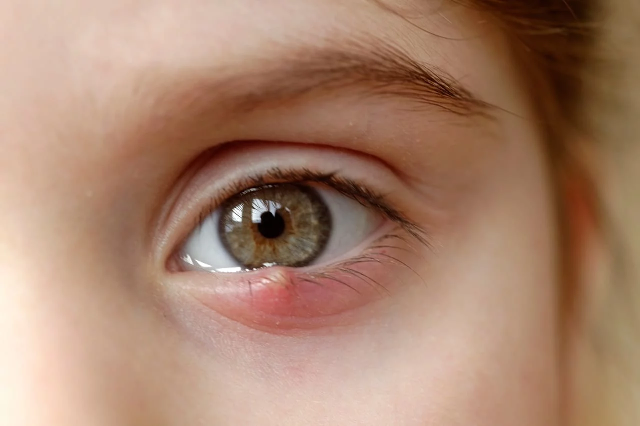 Libérate de los orzuelos con 8 eficaces soluciones: descubre el camino hacia unos ojos saludables y radiantes 2 Moncloa PREVENCIÓN Y CUIDADOS FUTUROS
