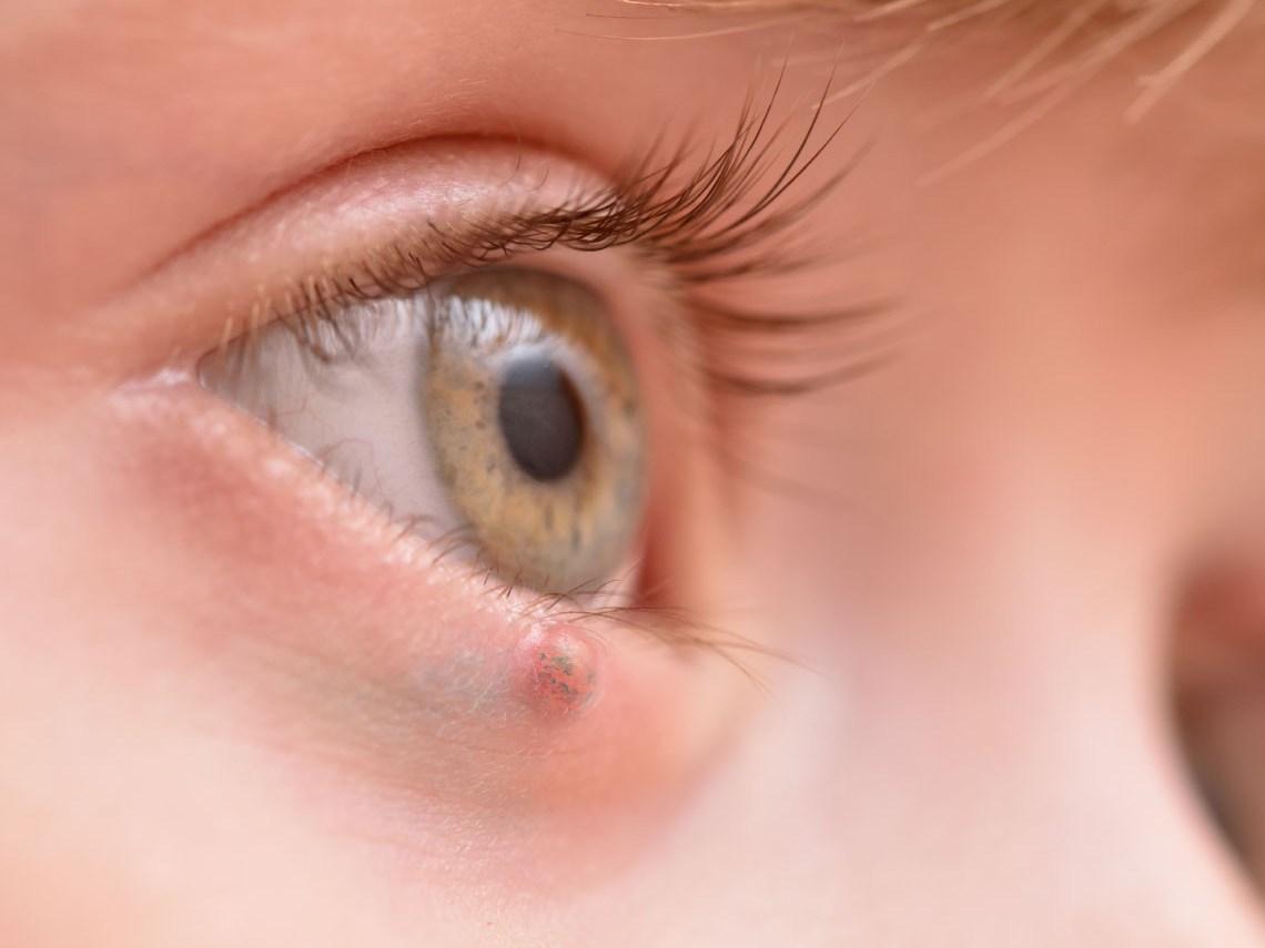 Libérate de los orzuelos con 8 eficaces soluciones: descubre el camino hacia unos ojos saludables y radiantes 1 Moncloa COMPRENDER LOS ORZUELOS