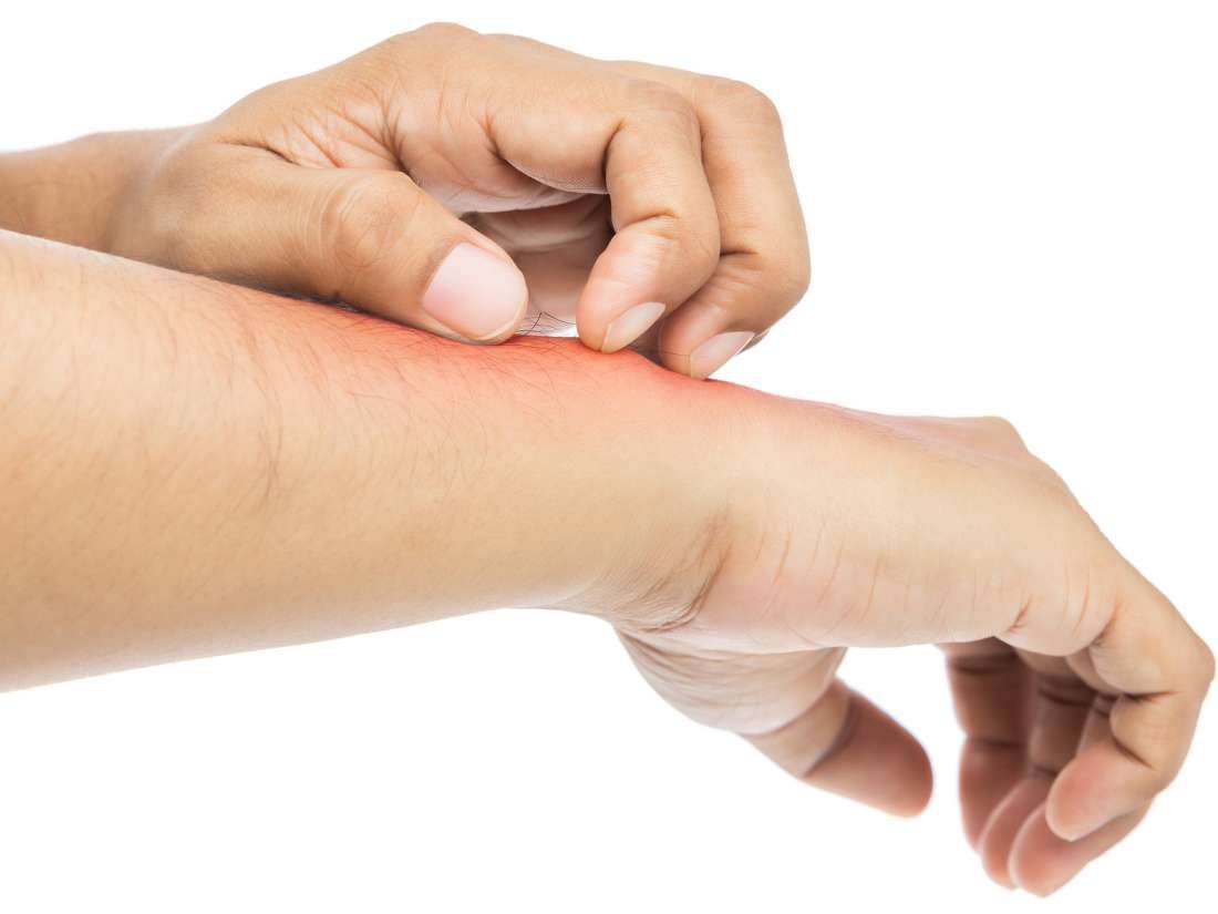Despídete de la molestia: 14 remedios naturales para aliviar la picazón y recuperar tu día sin interrupciones 2 Moncloa CUIDADO NATURAL PARA LAS PICADURAS DE INSECTOS