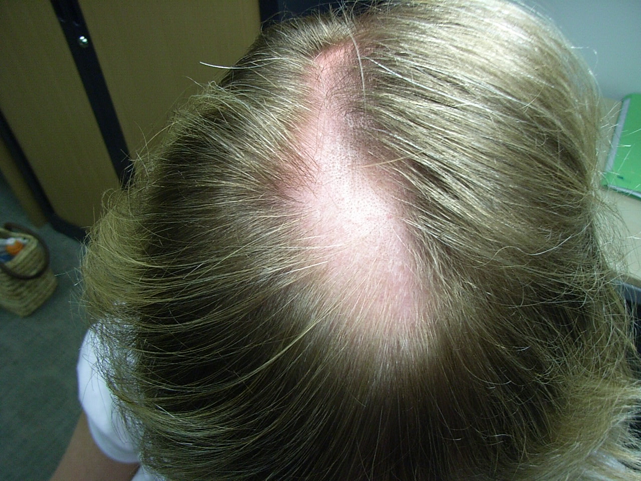 Descubre 7 soluciones naturales para combatir la alopecia. Estrategias efectivas respaldadas por la sabiduría ancestral y la ciencia 3 Moncloa EL ESTILO DE VIDA COMO ELEMENTO ESENCIAL
